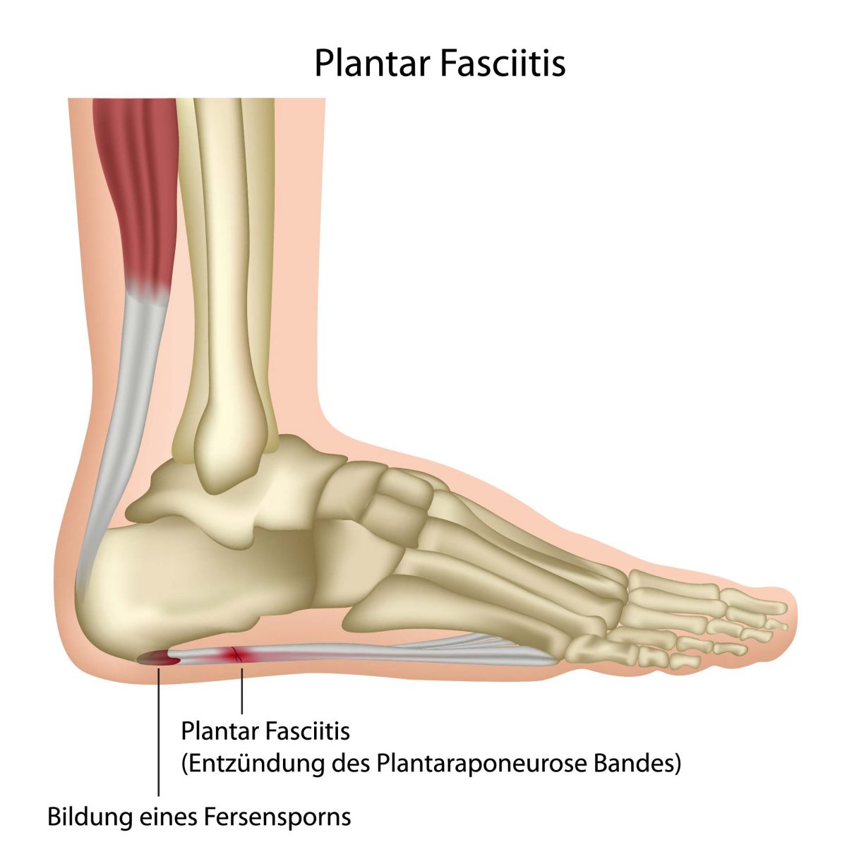 Plantar Fasciitis Ankle Sleeve 